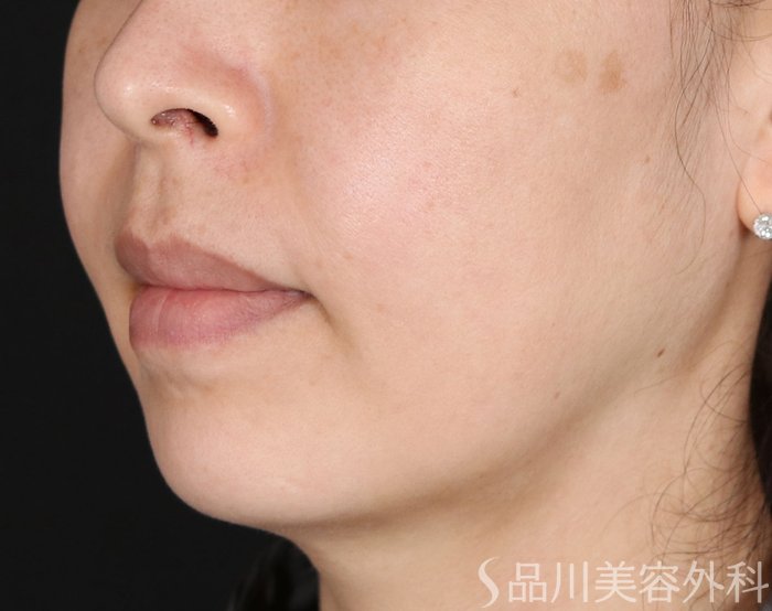 症例NO.71921のBEFORE写真