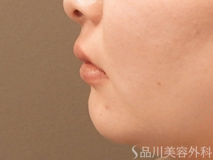 症例NO.69872のAFTER写真