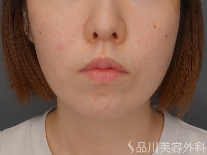 症例NO.64826のBEFORE写真