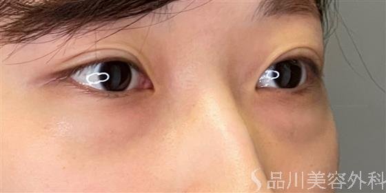 症例NO.51140のBEFORE写真
