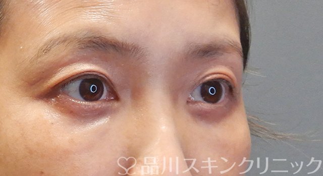 症例NO.75250のAFTER写真