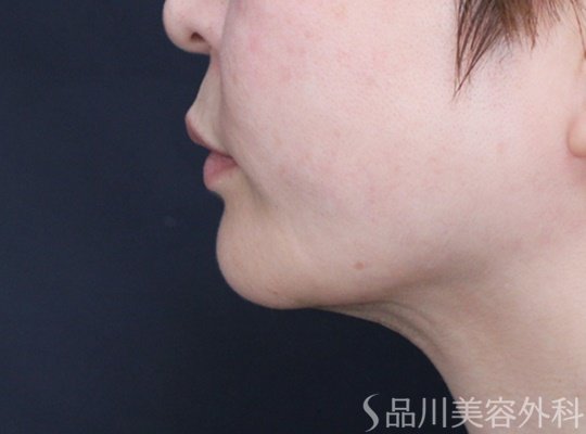 症例NO.69520のAFTER写真