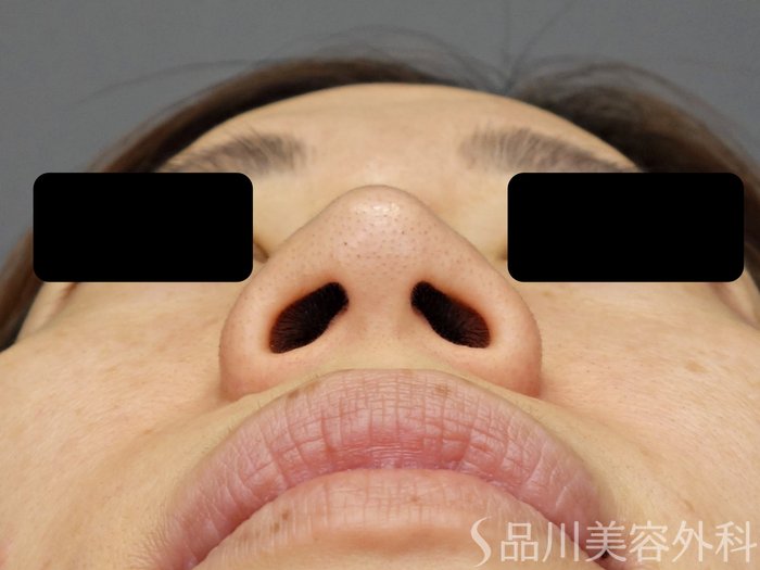 症例NO.72538のBEFORE写真