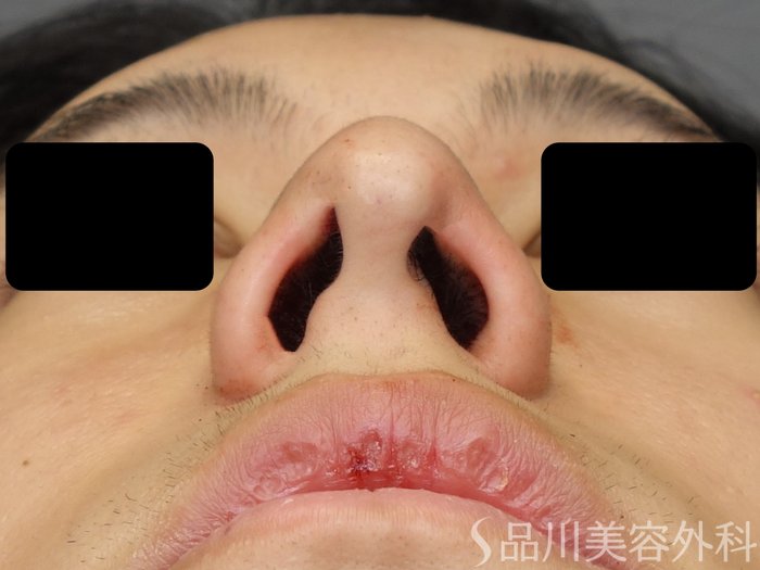 症例NO.67718のAFTER写真