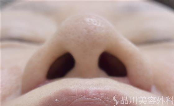 症例NO.45239のAFTER写真