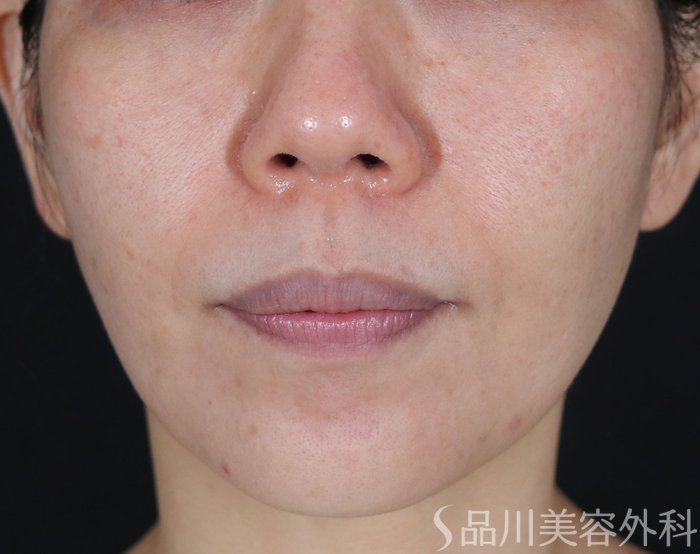 症例NO.71879のBEFORE写真