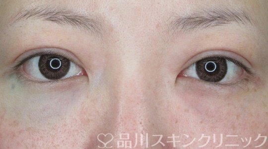 症例NO.68366のAFTER写真