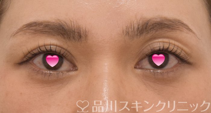 症例NO.74276のAFTER写真