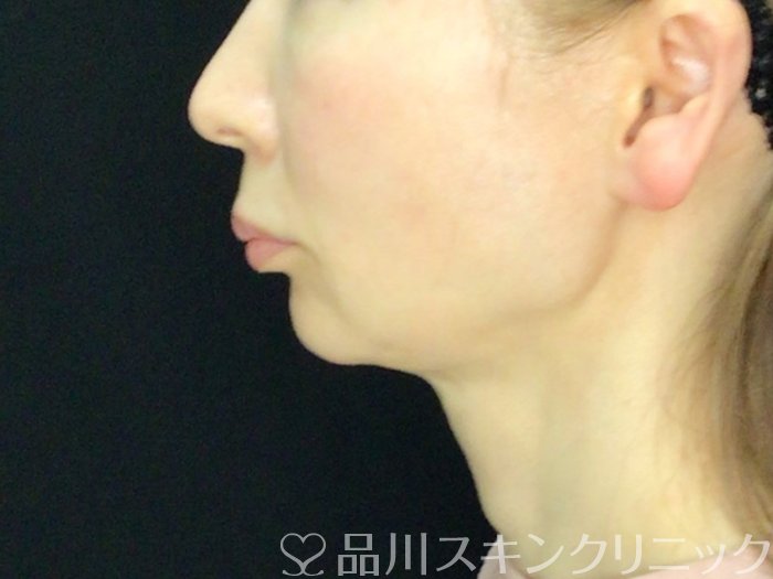 症例NO.72616のBEFORE写真