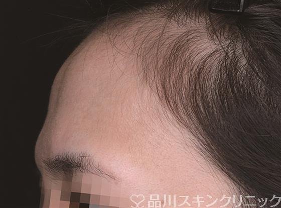 症例NO.54924のBEFORE写真