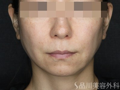 症例NO.69652のAFTER写真