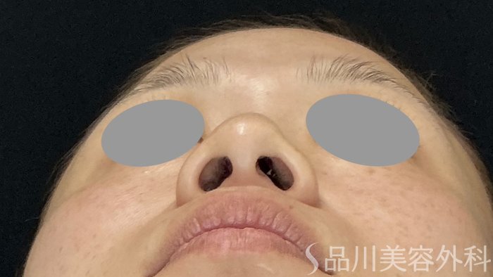 症例NO.74380のBEFORE写真