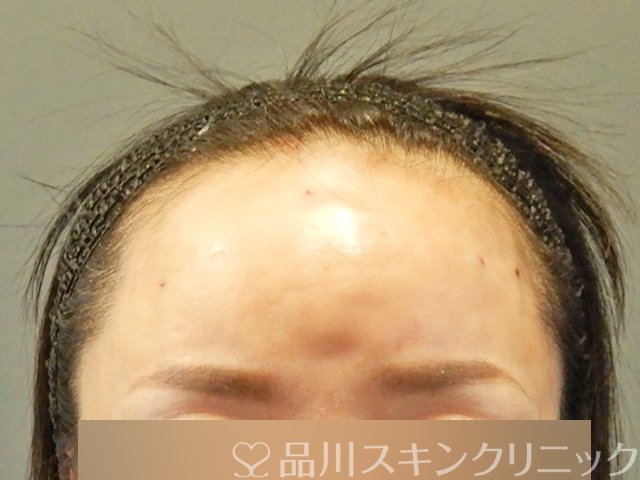 症例NO.66431のAFTER写真
