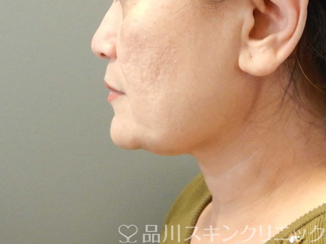 症例NO.66542のBEFORE写真