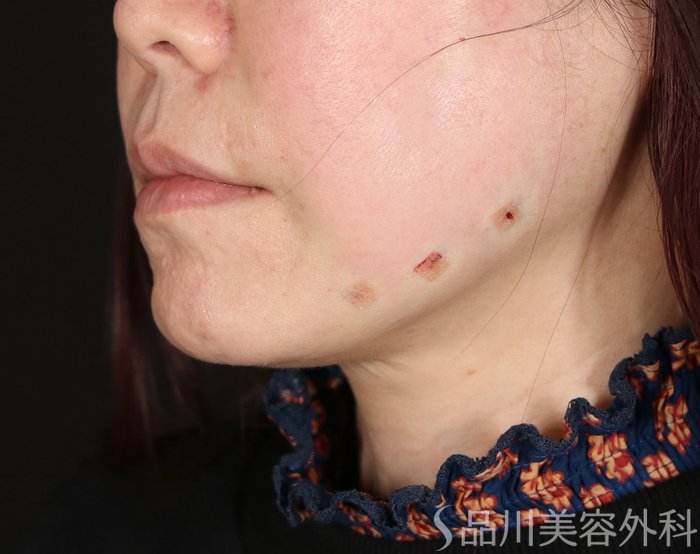 症例NO.73648のAFTER写真