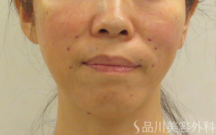 症例NO.72101のAFTER写真