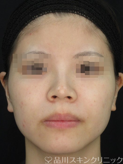 症例NO.73122のBEFORE写真