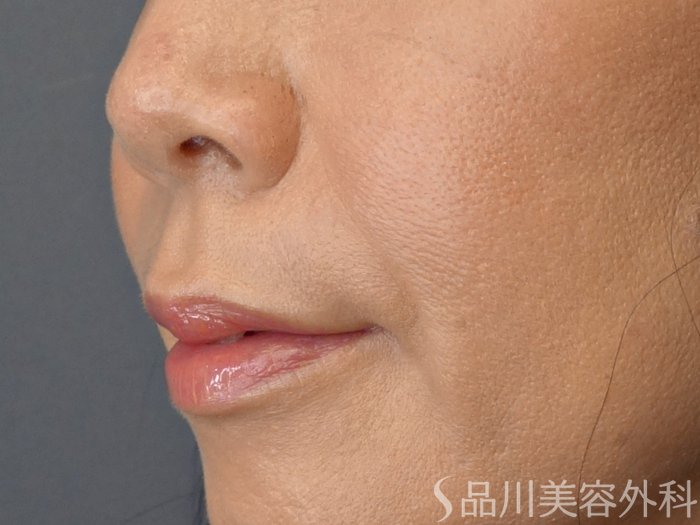 症例NO.72111のBEFORE写真