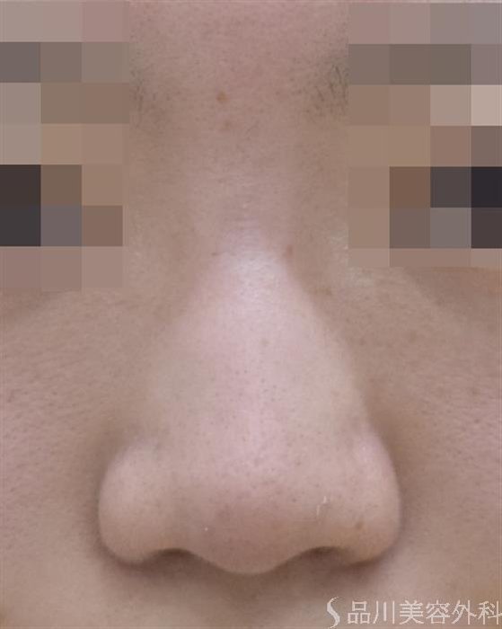 症例NO.47698のBEFORE写真
