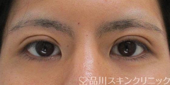 症例NO.42339のAFTER写真