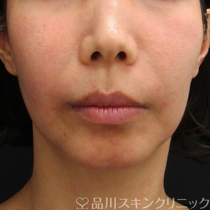 症例NO.75012のAFTER写真