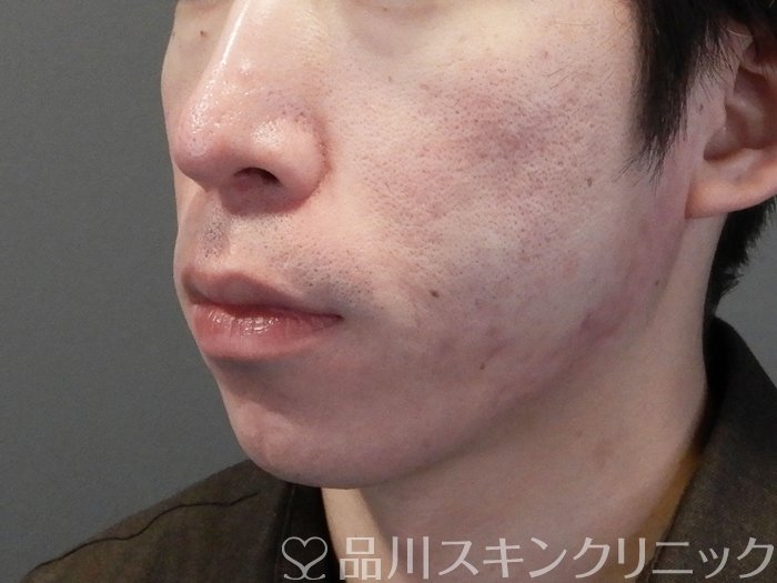 症例NO.69645のAFTER写真