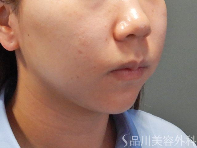 症例NO.74986のBEFORE写真