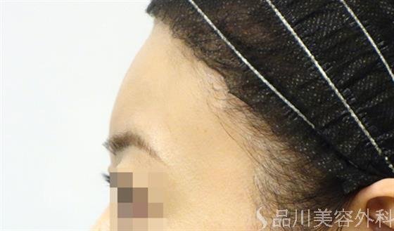 症例NO.33023のAFTER写真