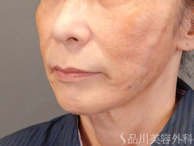 症例NO.75106のAFTER写真