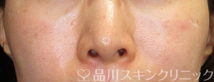 症例NO.74765のBEFORE写真