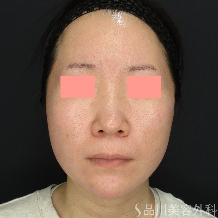 症例NO.73262のAFTER写真