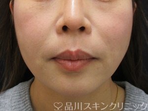症例NO.74285のAFTER写真