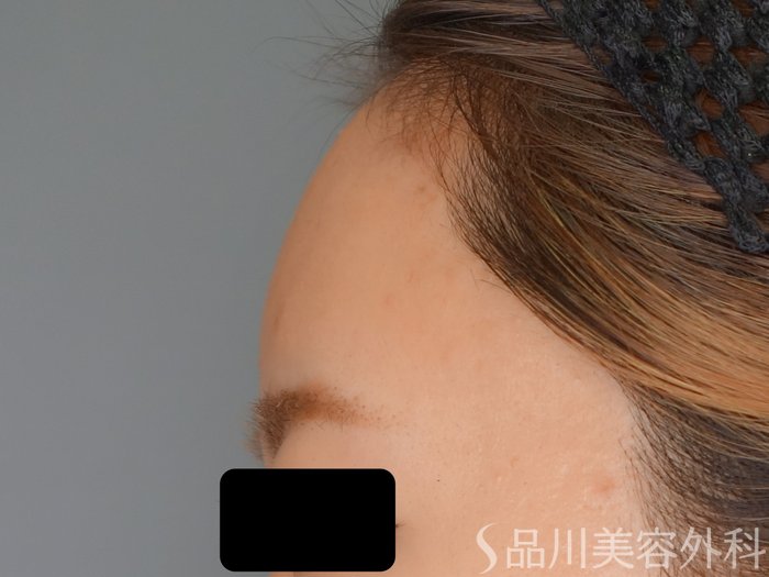 症例NO.70360のAFTER写真