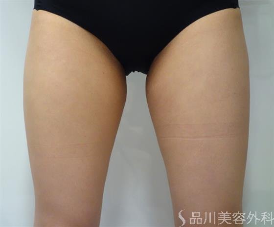 症例NO.43569のBEFORE写真