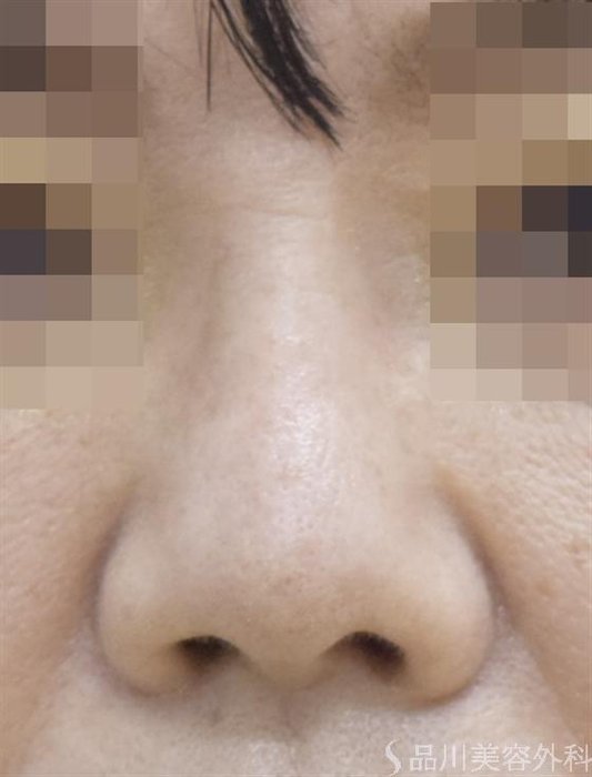 症例NO.51712のAFTER写真