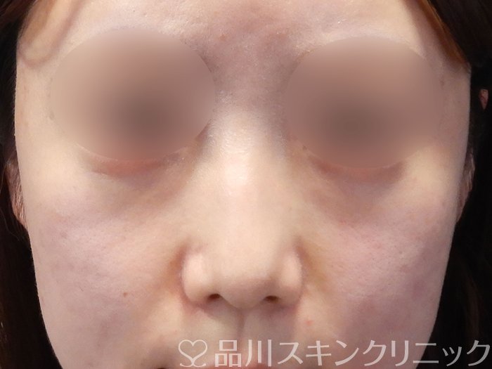 症例NO.72695のBEFORE写真