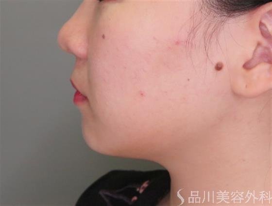 症例NO.48852のBEFORE写真