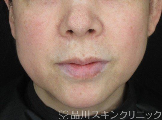 症例NO.70042のBEFORE写真