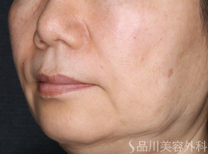 症例NO.72360のAFTER写真