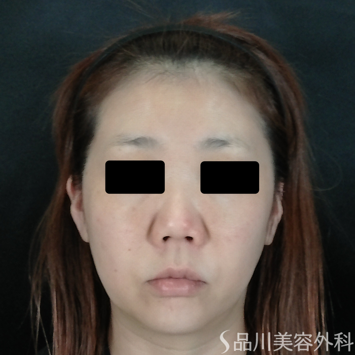 症例NO.72628のBEFORE写真