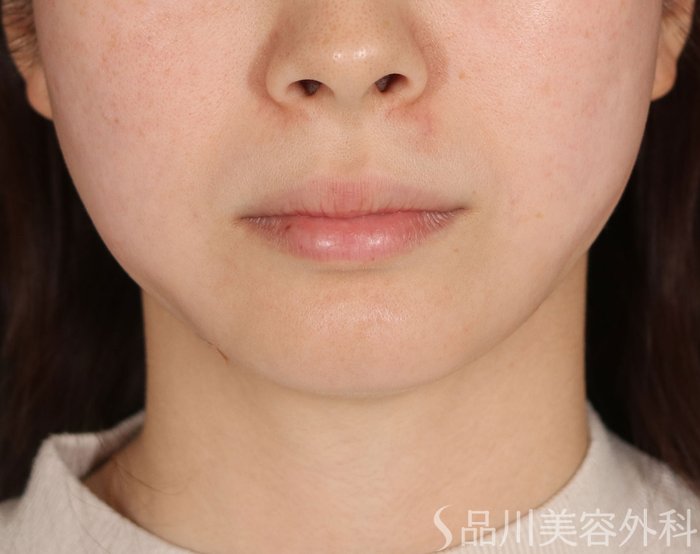症例NO.73795のAFTER写真