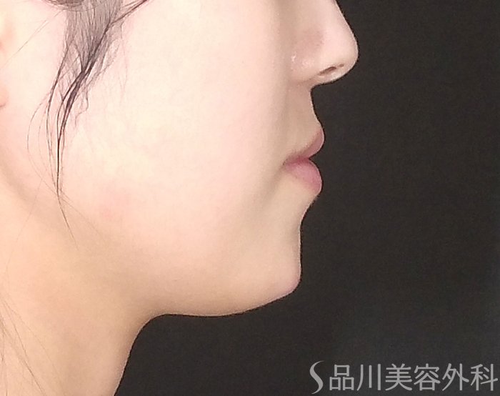 症例NO.70103のAFTER写真