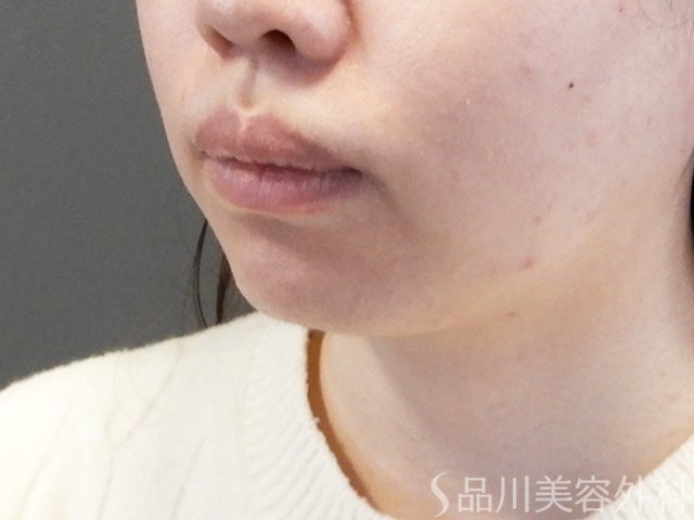 症例NO.67998のBEFORE写真