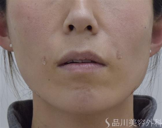 症例NO.51898のAFTER写真
