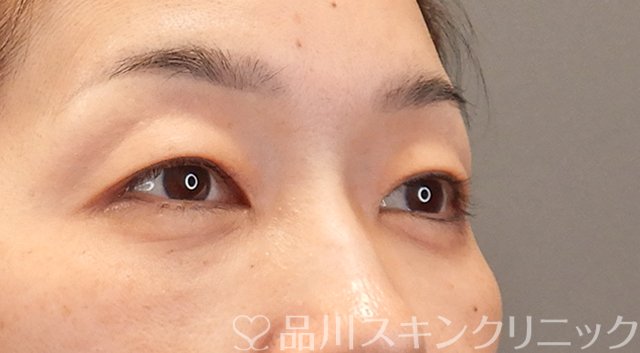 症例NO.75318のAFTER写真