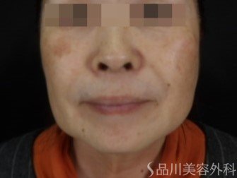 症例NO.73530のBEFORE写真