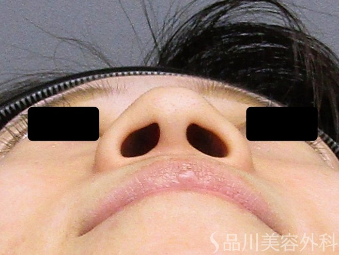 症例NO.74892のBEFORE写真