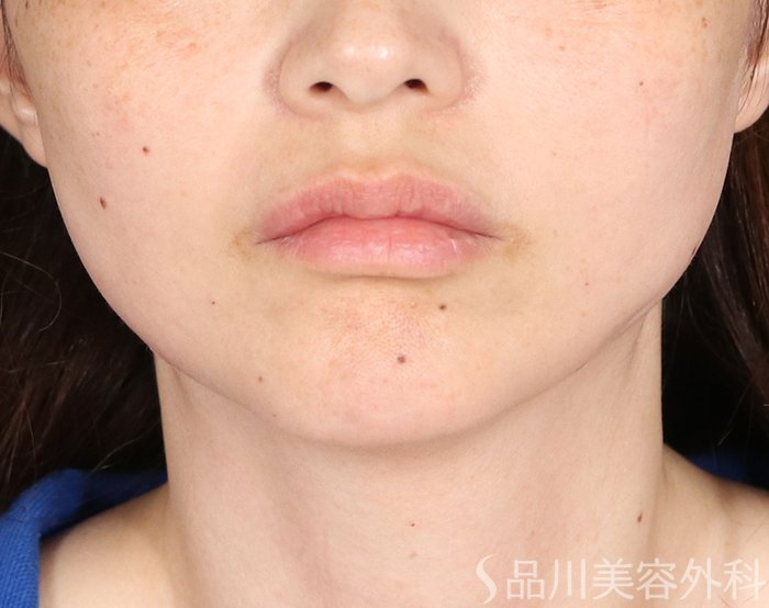 症例NO.74014のAFTER写真
