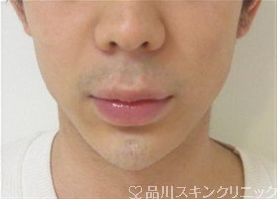 症例NO.34424のAFTER写真