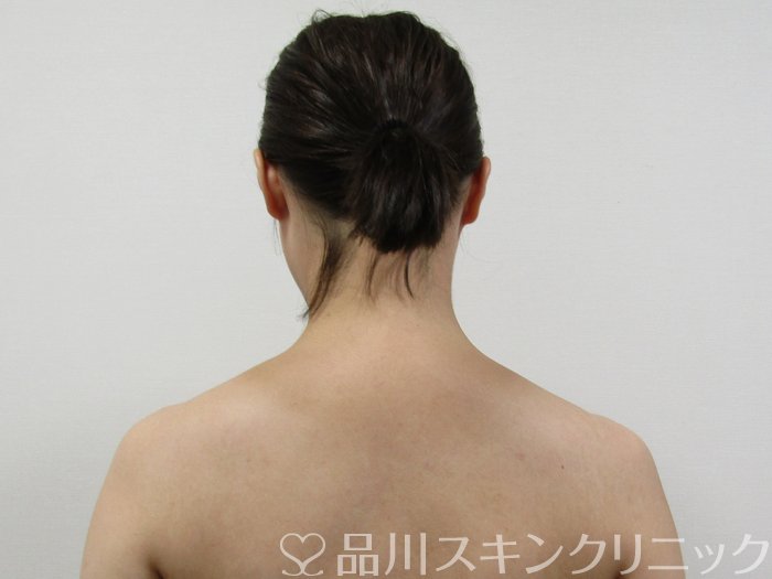 症例NO.75219のBEFORE写真
